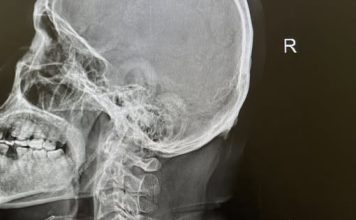 ‘ปวดหัวข้างเดียว’มา 3 ปีไม่หายขาด??? หมอชี้อาจ‘คอเสื่อม’ที่ปลอมเป็น‘ไมเกรน’