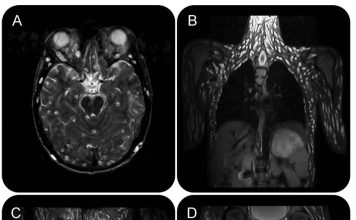 เปิดเคสสุดช็อก!!ชายวัย 18 ปีแข็งแรงดี กลายเป็นอาณาจักรตัวอ่อนพยาธิตืดหมู