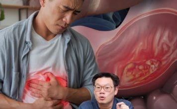 อย่าชะล่าใจ!“หมอเจด”ชีเคสชายวัย39 นึกว่ากรดไหลย้อนแต่คือ“มะเร็งลำไส้”